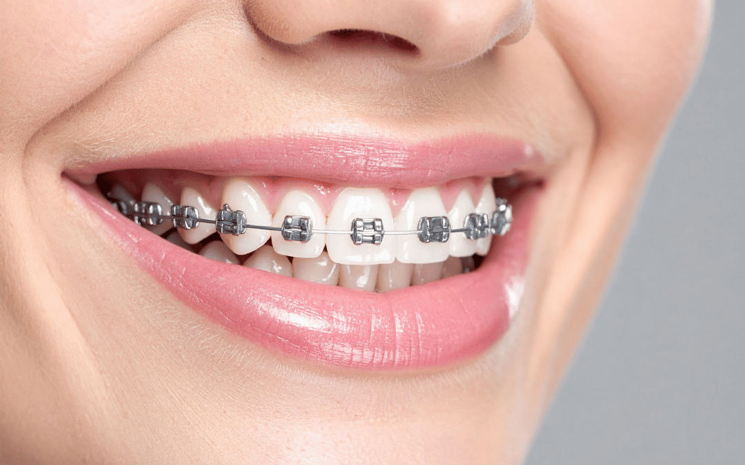 Sun Orthodontist Braces & Invisalign Miami